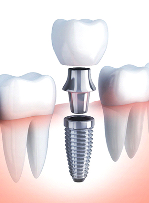 dental implant diagram 