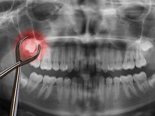 red tooth on x-ray